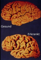 Kurkuma bei Alzheimer